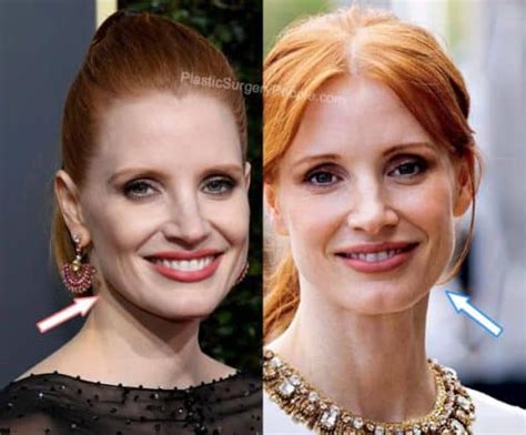 jessica chastain plastic surgery|Jessica Chastain, Before and After